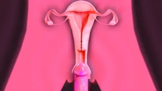 (X-ray) How to impregnate Tifa