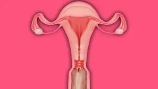 Penetrazione intensa di tentacoli a raggi X